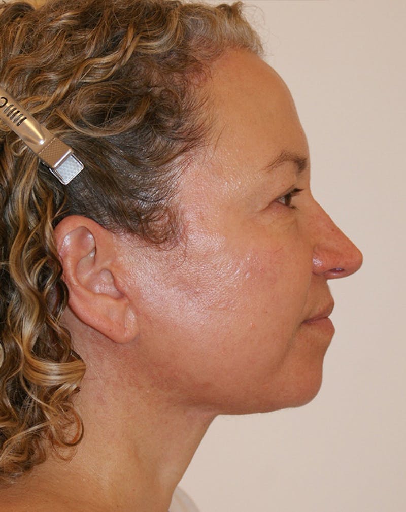Facelift/Necklift Before & After Gallery - Patient 309331 - Image 8