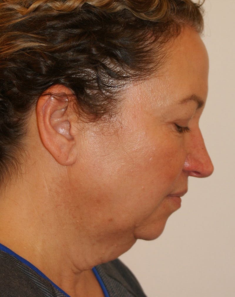 Facelift/Necklift Before & After Gallery - Patient 309331 - Image 9