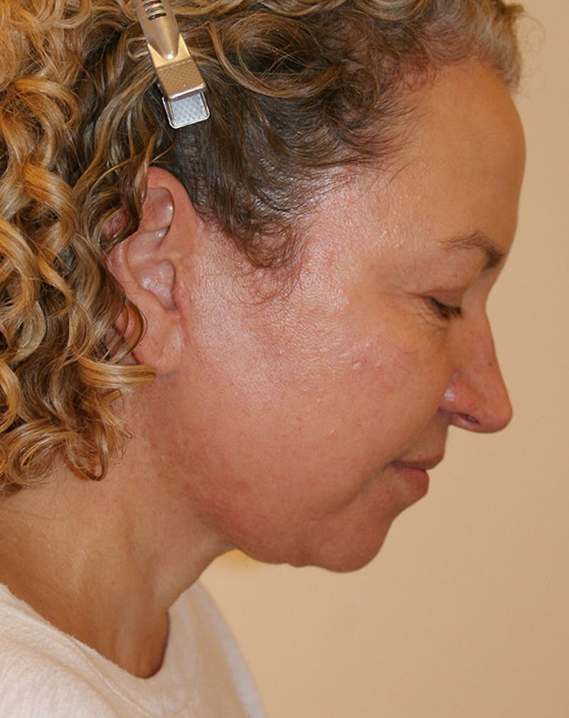 Facelift/Necklift Before & After Gallery - Patient 309331 - Image 10