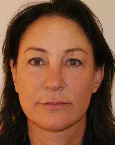 Facelift/Necklift Before & After Gallery - Patient 347351 - Image 2