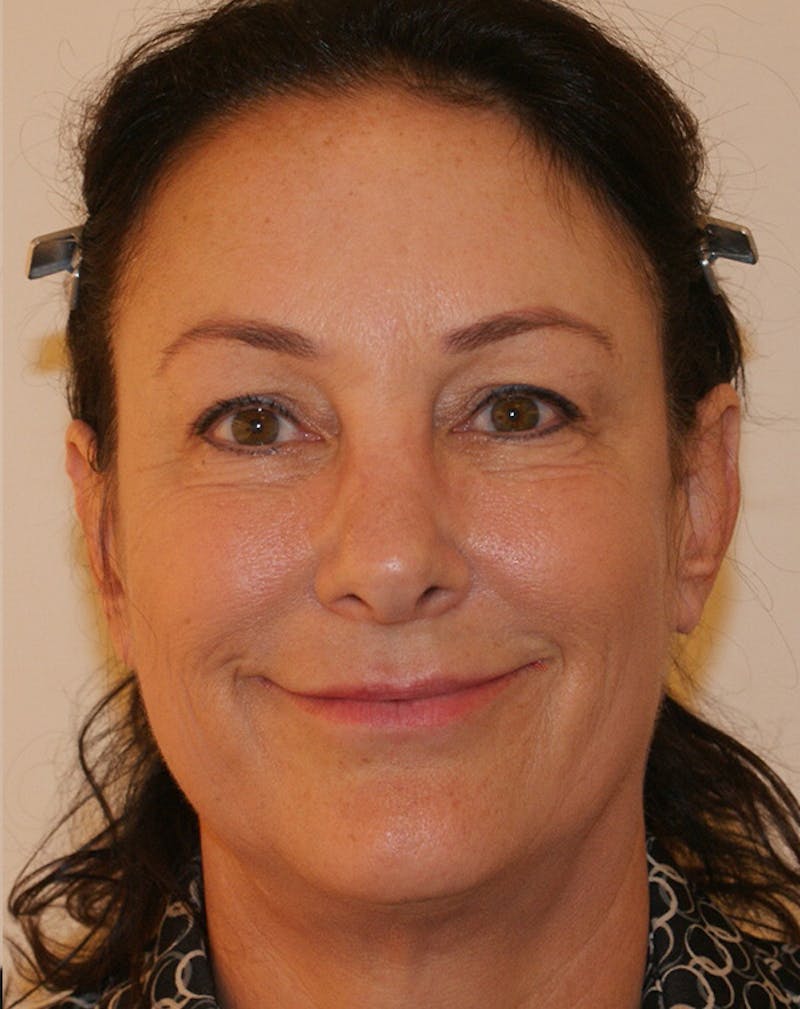 Facelift/Necklift Before & After Gallery - Patient 347351 - Image 3