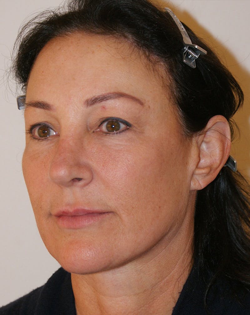Facelift/Necklift Before & After Gallery - Patient 347351 - Image 6