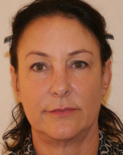 Facelift/Necklift Before & After Gallery - Patient 347351 - Image 1