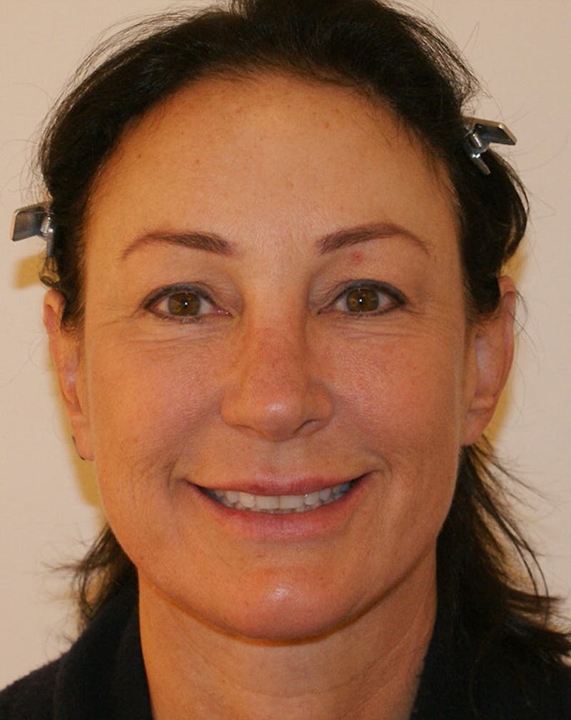 Facelift/Necklift Before & After Gallery - Patient 347351 - Image 4