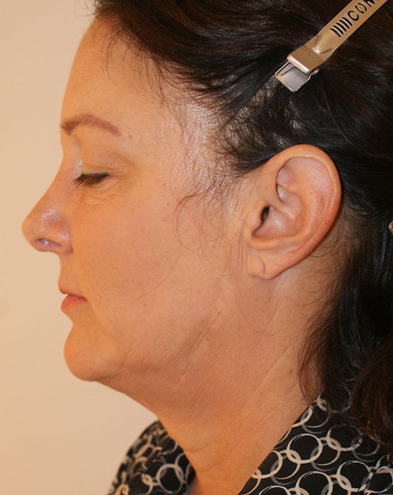 Facelift/Necklift Before & After Gallery - Patient 347351 - Image 7
