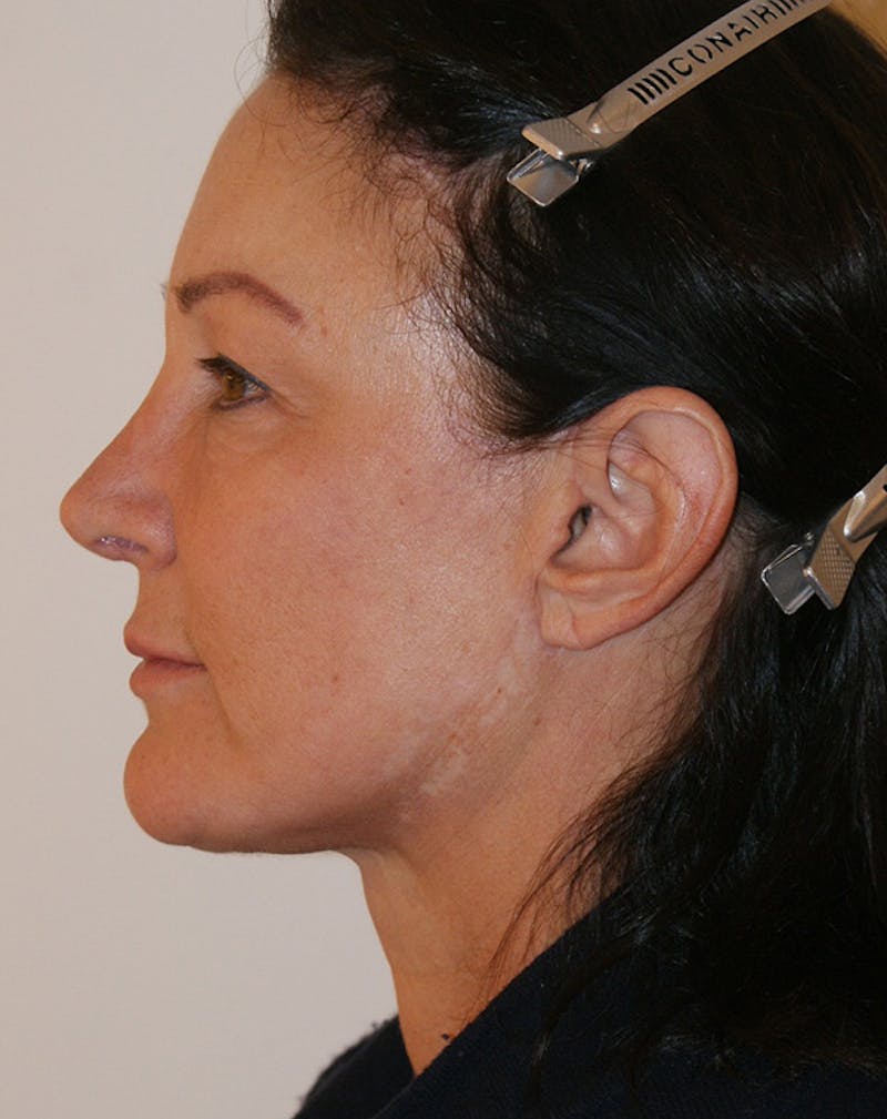Facelift/Necklift Before & After Gallery - Patient 347351 - Image 8