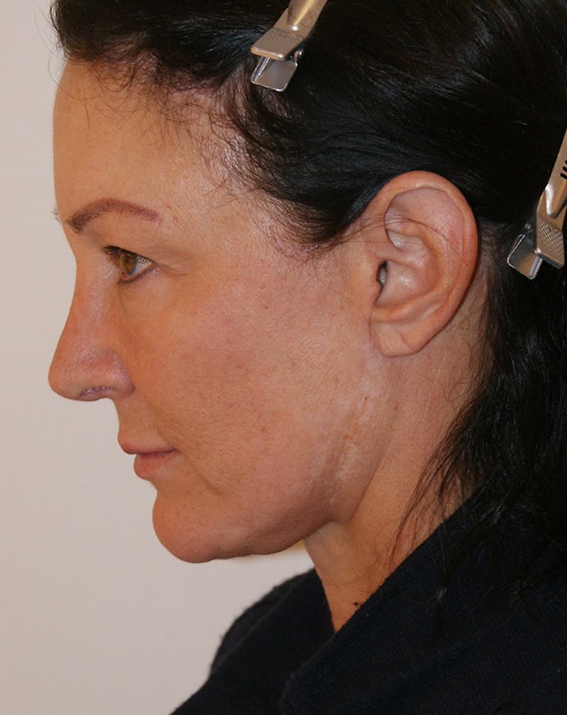 Facelift/Necklift Before & After Gallery - Patient 347351 - Image 10