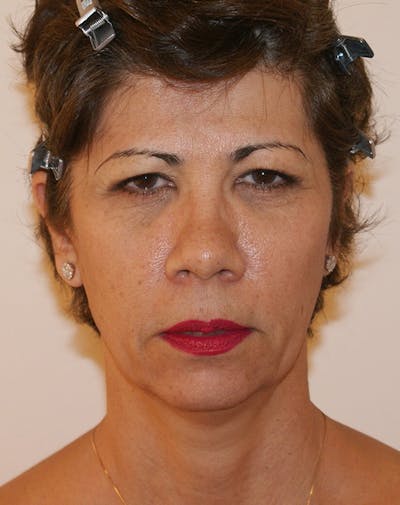Facelift/Necklift Before & After Gallery - Patient 372228 - Image 1