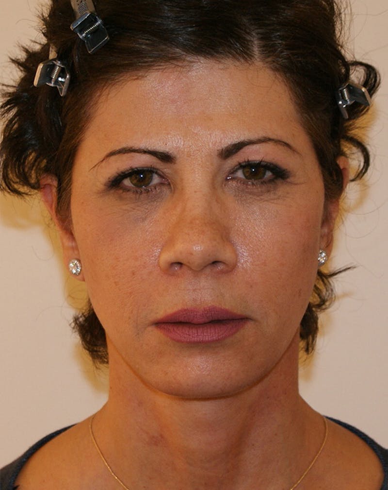 Facelift/Necklift Before & After Gallery - Patient 372228 - Image 2
