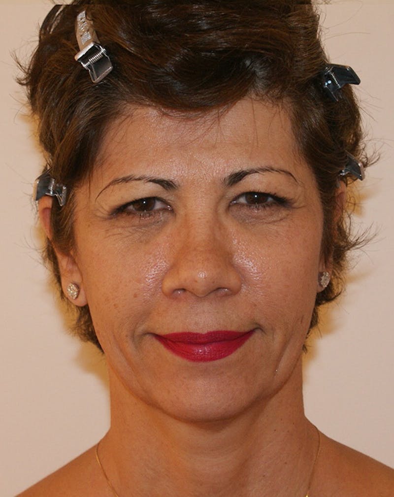 Facelift/Necklift Before & After Gallery - Patient 372228 - Image 3