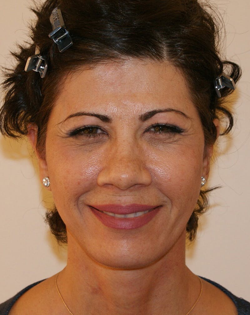 Facelift/Necklift Before & After Gallery - Patient 372228 - Image 4