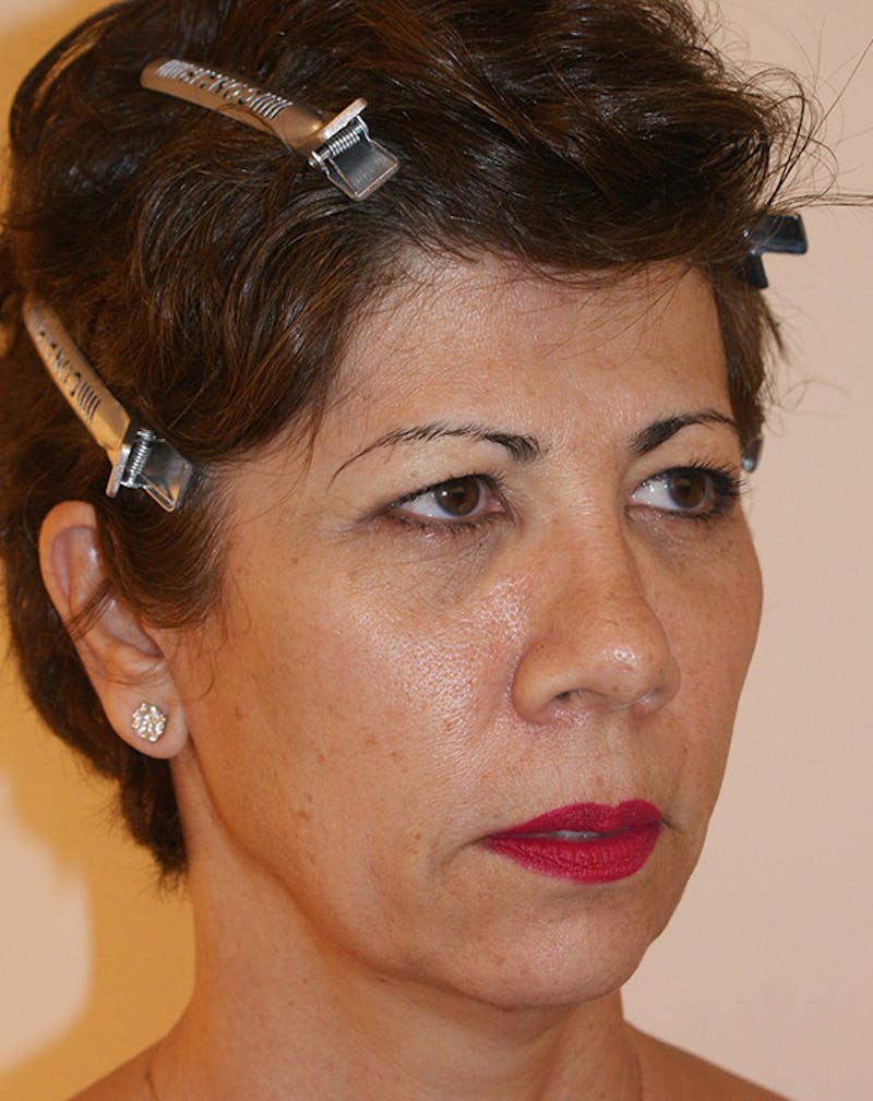 Facelift/Necklift Before & After Gallery - Patient 372228 - Image 5