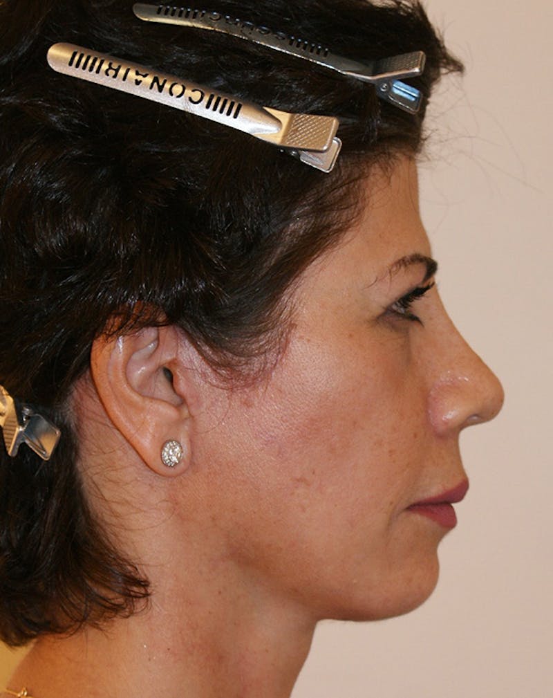Facelift/Necklift Before & After Gallery - Patient 372228 - Image 8