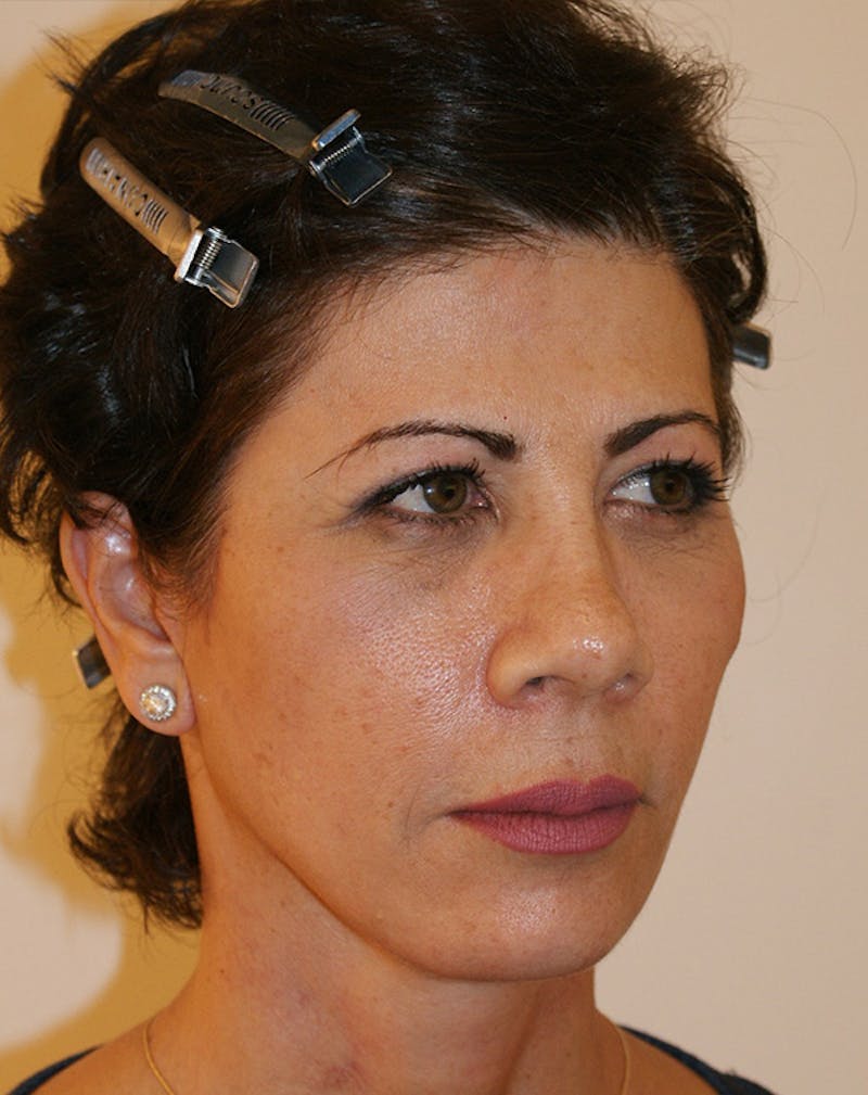Facelift/Necklift Before & After Gallery - Patient 372228 - Image 6