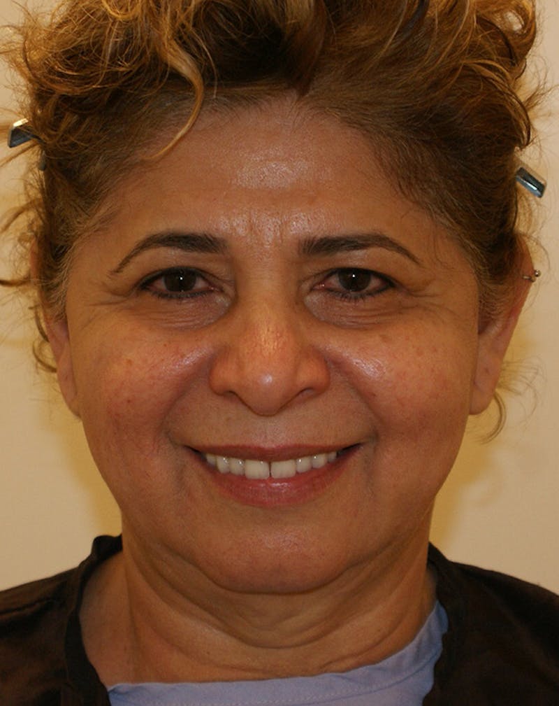 Facelift/Necklift Before & After Gallery - Patient 190655 - Image 3