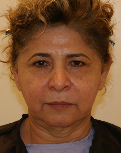 Facelift/Necklift Before & After Gallery - Patient 190655 - Image 1