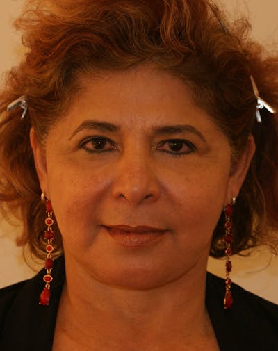 Facelift/Necklift Before & After Gallery - Patient 190655 - Image 2