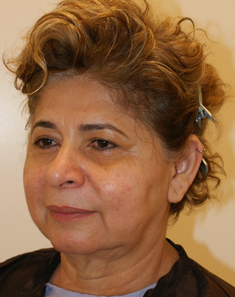 Facelift/Necklift Before & After Gallery - Patient 190655 - Image 5
