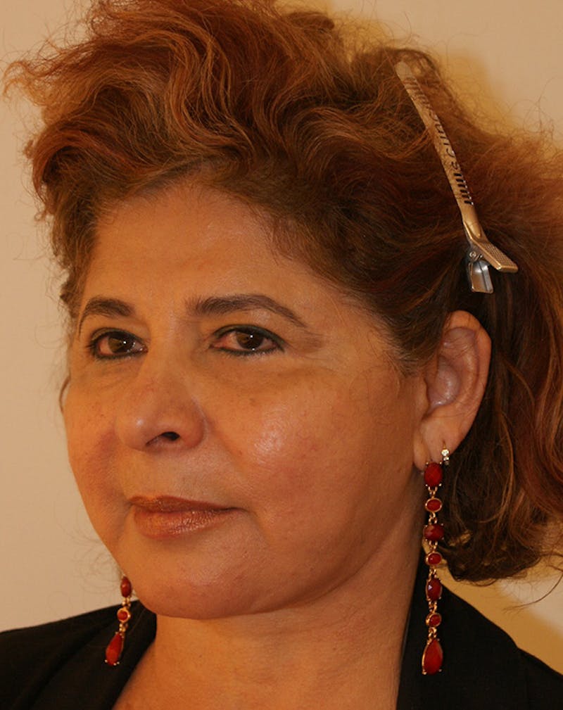 Facelift/Necklift Before & After Gallery - Patient 190655 - Image 6