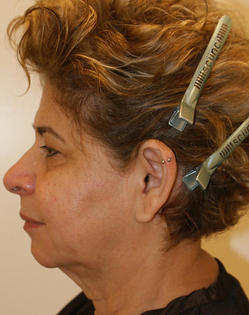 Facelift/Necklift Before & After Gallery - Patient 190655 - Image 7