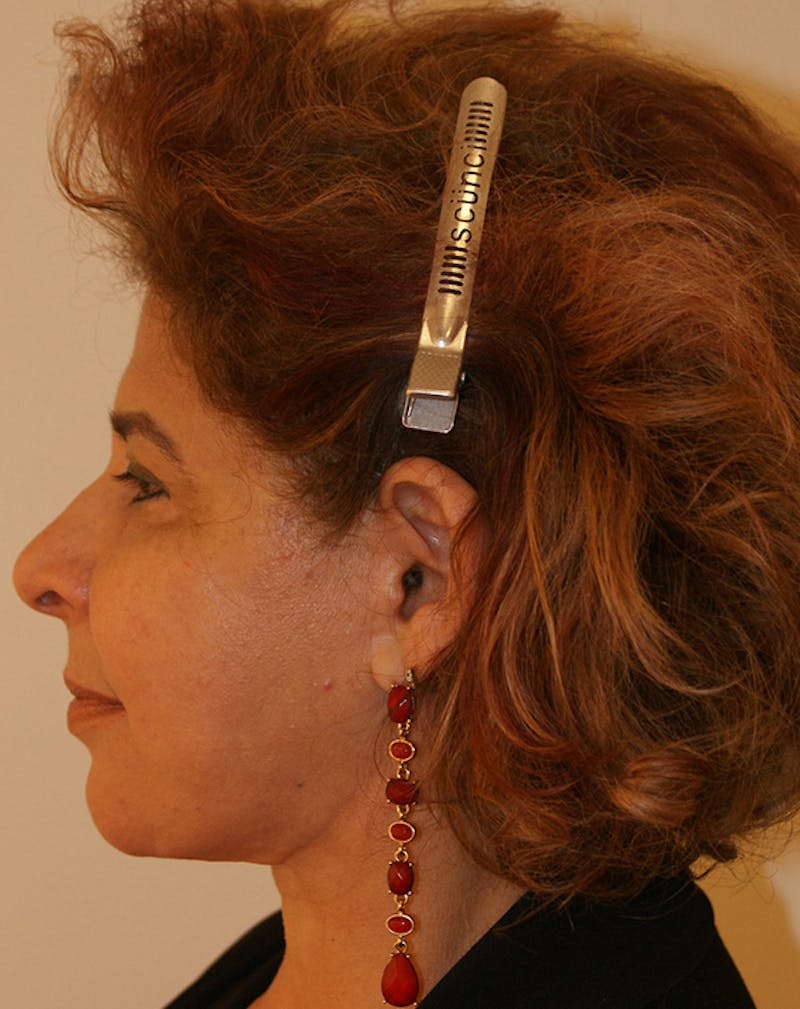 Facelift/Necklift Before & After Gallery - Patient 190655 - Image 8