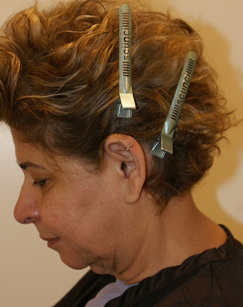 Facelift/Necklift Before & After Gallery - Patient 190655 - Image 9