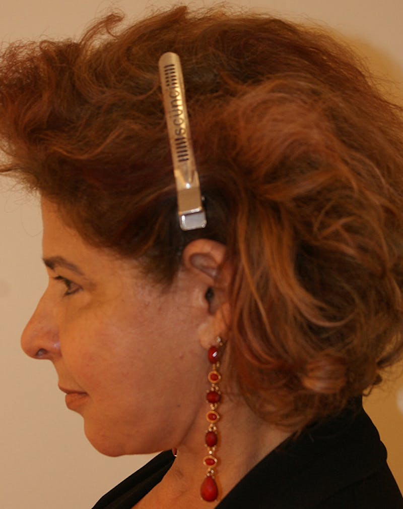 Facelift/Necklift Before & After Gallery - Patient 190655 - Image 10