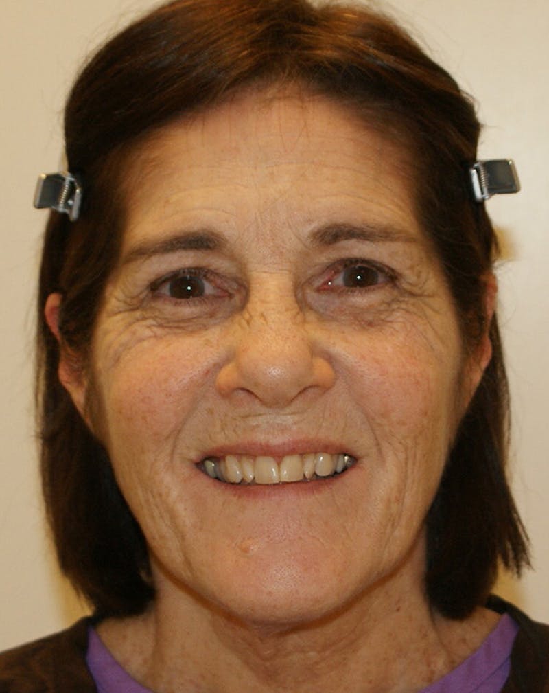 Facelift/Necklift Before & After Gallery - Patient 224980 - Image 3