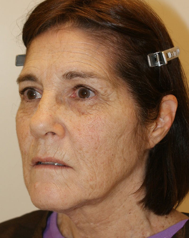 Facelift/Necklift Before & After Gallery - Patient 224980 - Image 5