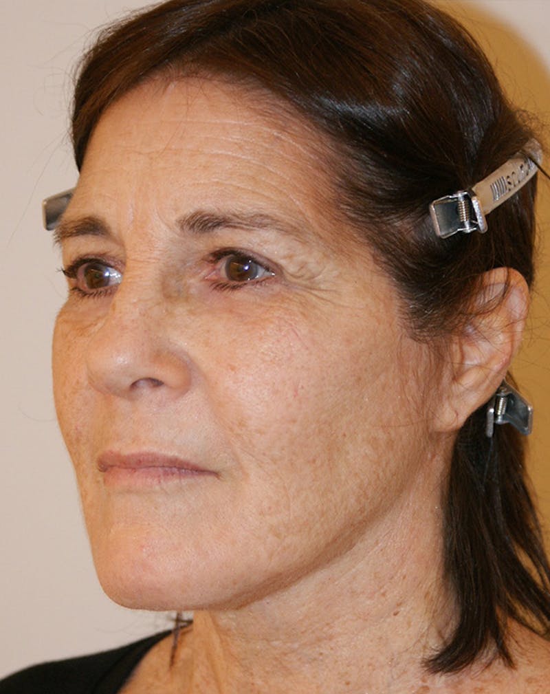 Facelift/Necklift Before & After Gallery - Patient 224980 - Image 6