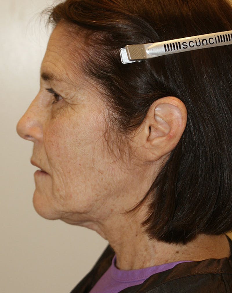 Facelift/Necklift Before & After Gallery - Patient 224980 - Image 7