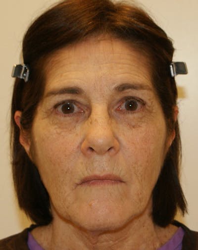 Facelift/Necklift Before & After Gallery - Patient 224980 - Image 1