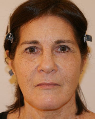 Facelift/Necklift Before & After Gallery - Patient 224980 - Image 2