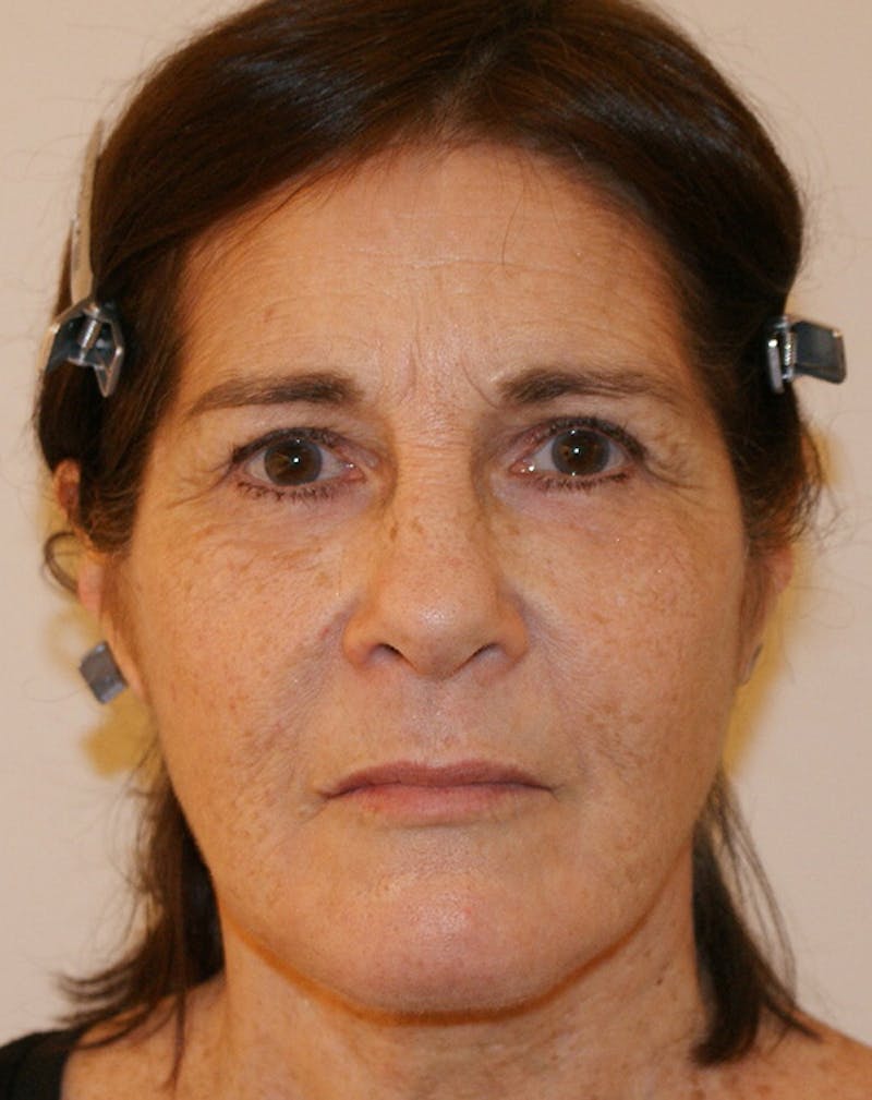 Facelift/Necklift Before & After Gallery - Patient 224980 - Image 2