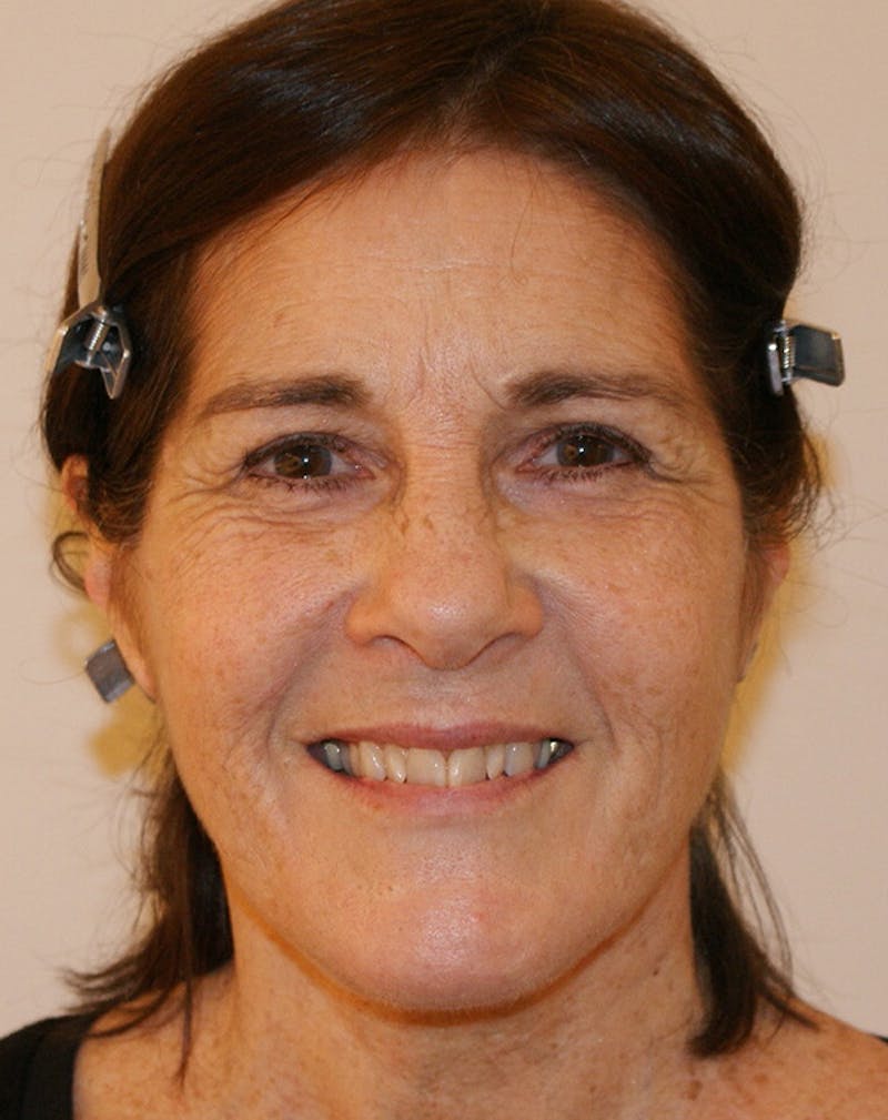 Facelift/Necklift Before & After Gallery - Patient 224980 - Image 4