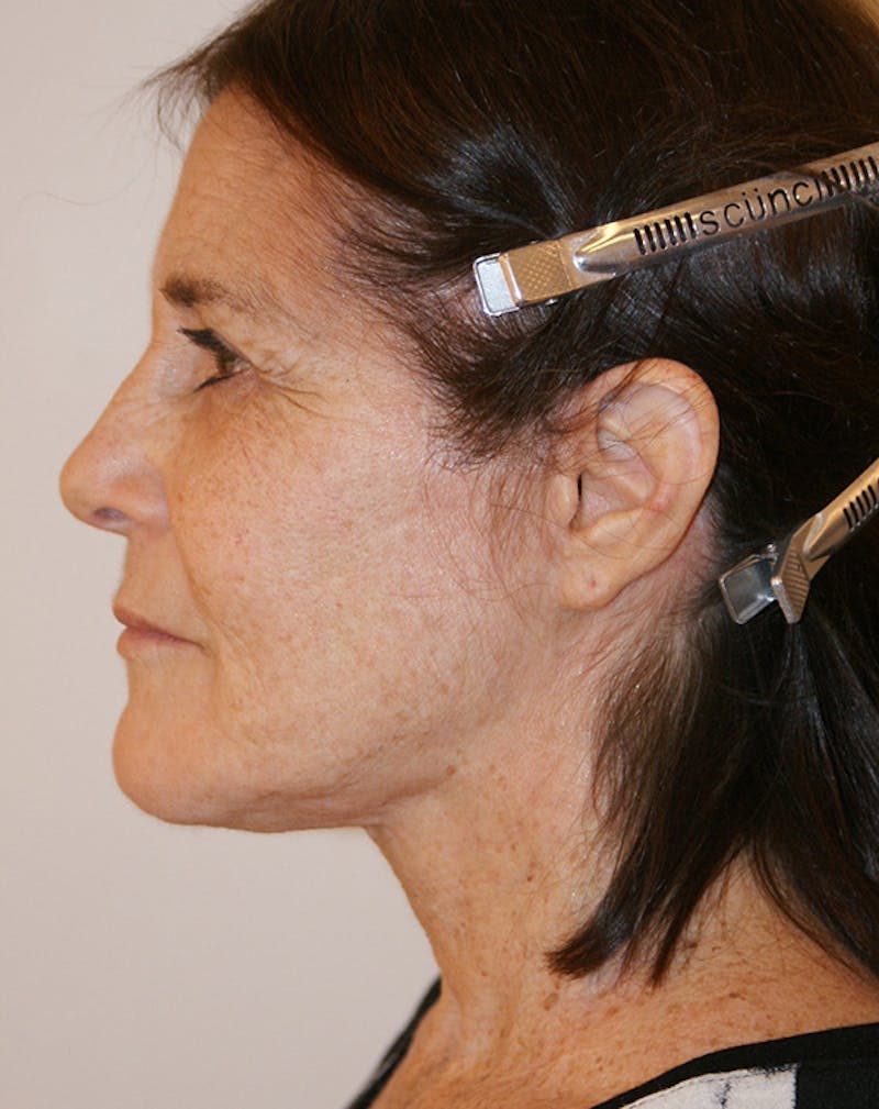 Facelift/Necklift Before & After Gallery - Patient 224980 - Image 8