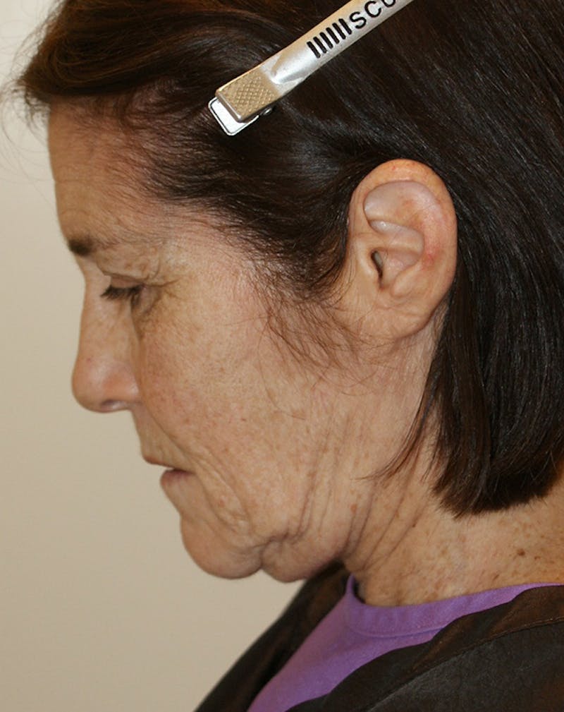 Facelift/Necklift Before & After Gallery - Patient 224980 - Image 9
