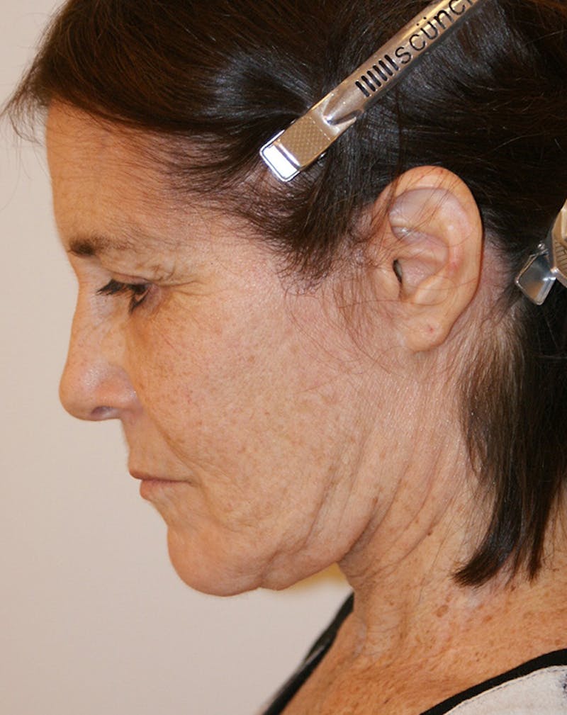 Facelift/Necklift Before & After Gallery - Patient 224980 - Image 10