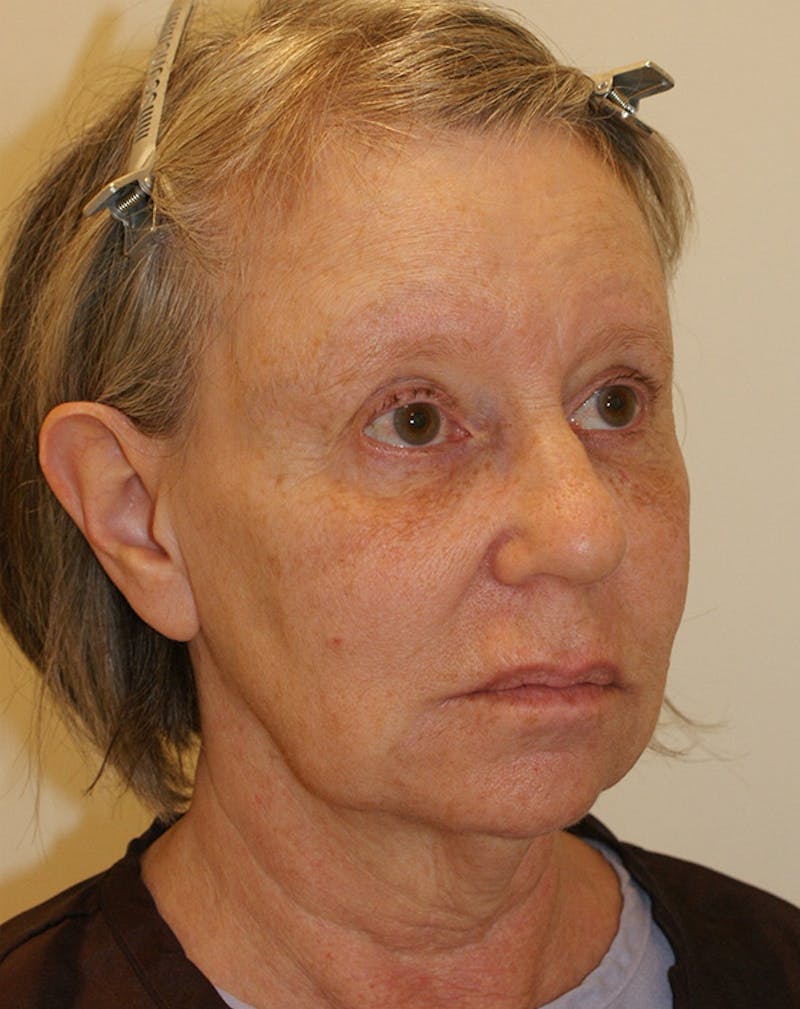 Facelift/Necklift Before & After Gallery - Patient 337140 - Image 5