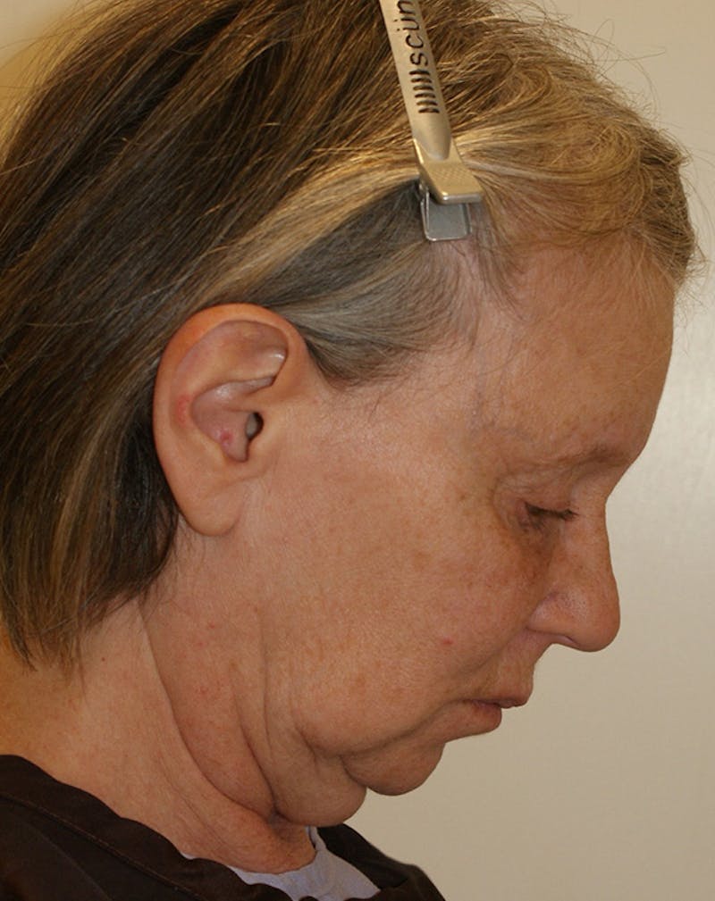 Facelift/Necklift Before & After Gallery - Patient 337140 - Image 9
