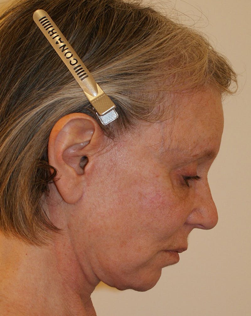 Facelift/Necklift Before & After Gallery - Patient 337140 - Image 10