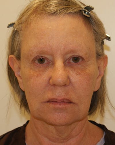 Facelift/Necklift Before & After Gallery - Patient 337140 - Image 1