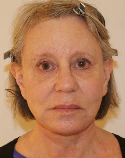 Facelift/Necklift Before & After Gallery - Patient 337140 - Image 2