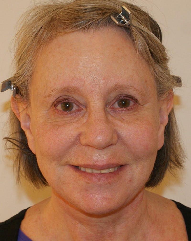 Facelift/Necklift Before & After Gallery - Patient 337140 - Image 4