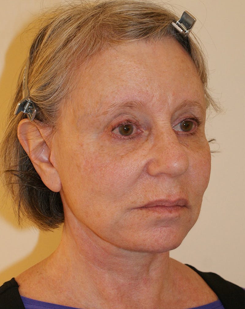 Facelift/Necklift Before & After Gallery - Patient 337140 - Image 6
