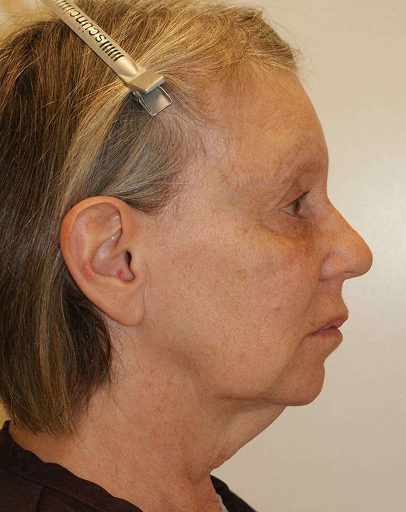 Facelift/Necklift Before & After Gallery - Patient 337140 - Image 7