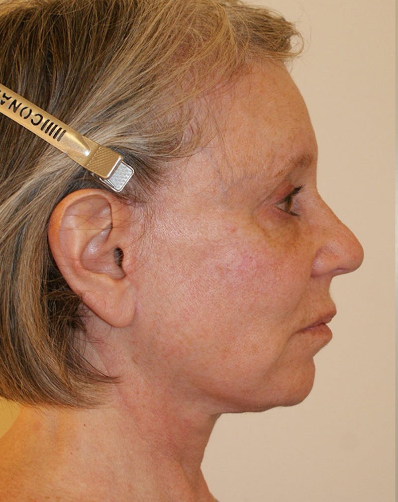 Facelift/Necklift Before & After Gallery - Patient 337140 - Image 8