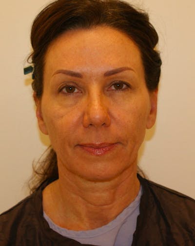 Facelift/Necklift Before & After Gallery - Patient 311795 - Image 1