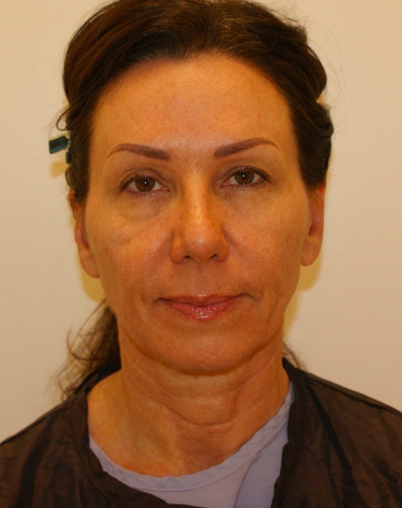 Facelift/Necklift Before & After Gallery - Patient 311795 - Image 1