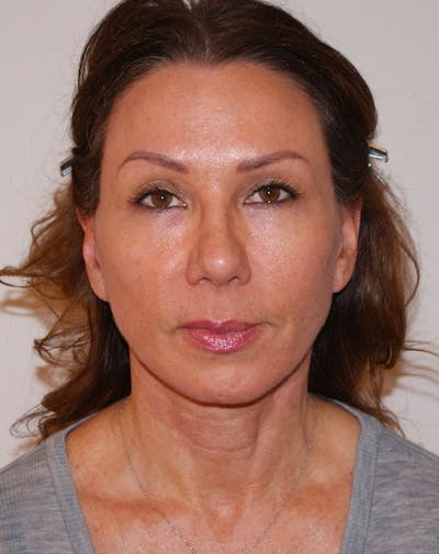 Facelift/Necklift Before & After Gallery - Patient 311795 - Image 2